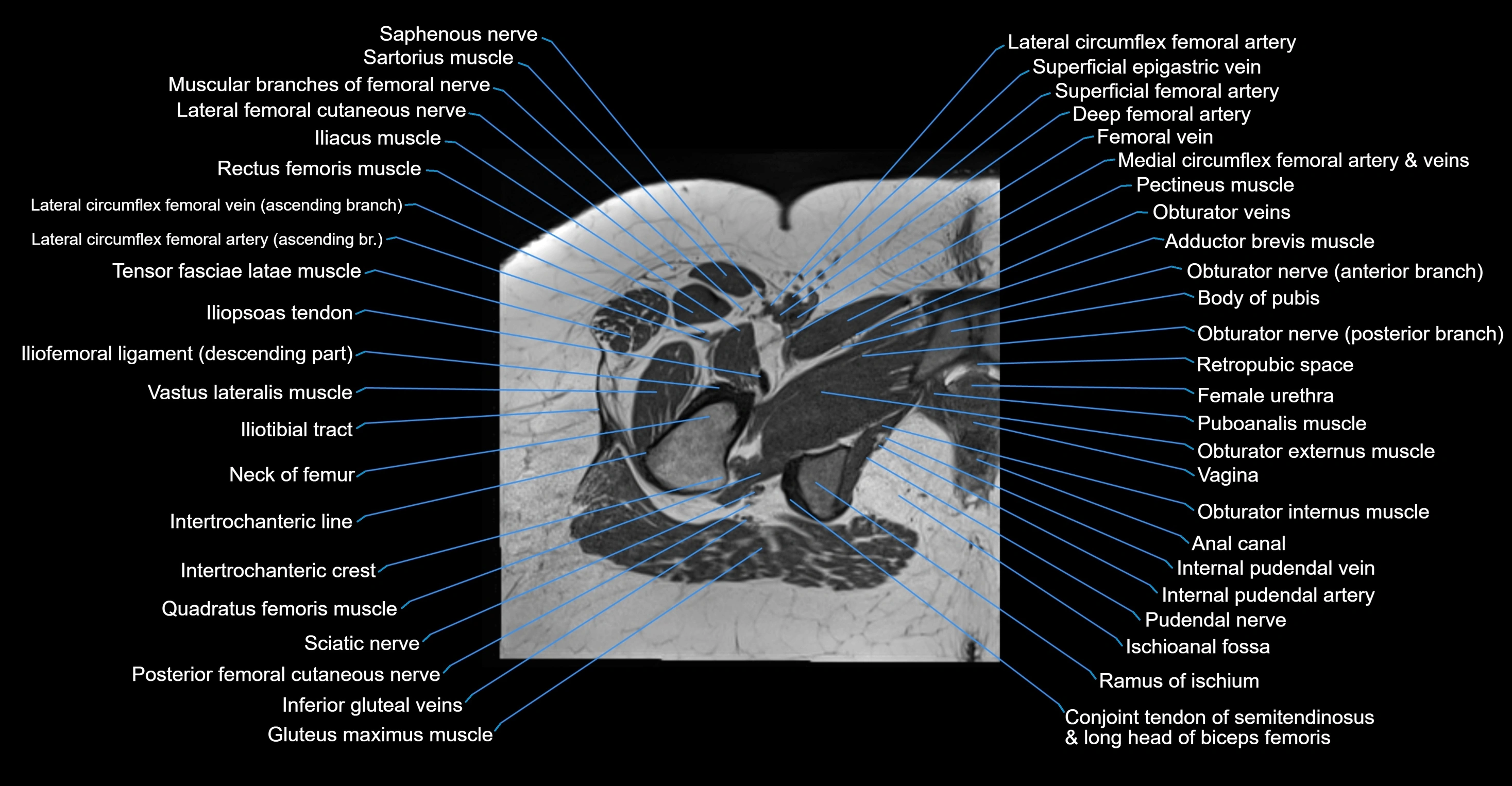 MRI hip axial cross sectional anatomy 3T 3D  radiology  anatomy image-img-00001-00056.webp